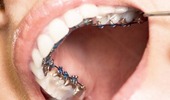 Teeth Straightening